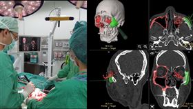 手術中同步利用導航系統協助定位，逐步將錯位的骨塊復位至理想位置。（圖／馬偕醫院提供）