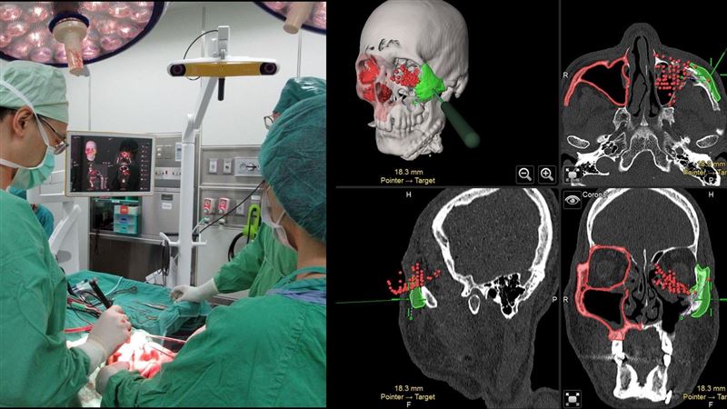 他出車禍3個月仍「臉歪」醫1塊塊拼回重建