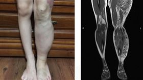 小柔一出生就罹罕見「血管腫瘤」左腳比右腳大N倍。（圖／北醫附醫提供）