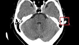 電腦斷層影像看見筷子深入頭皮下方2.5公分，但所幸未穿透顱骨。（圖／台北慈濟醫院提供）