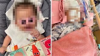 女嬰疑遭保母不當對待　醫：恐雙眼失明