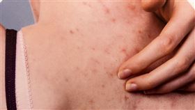 青春痘、背痘讓部分民眾好困擾。（圖／記者簡浩正攝影）