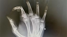 全台掀起拳擊運動熱潮，患者模仿拳擊手揮拳，一時激動以拳頭捶打牆壁，導致右手掌第5掌骨頸部骨折。（圖／高雄中正脊椎骨科提供）