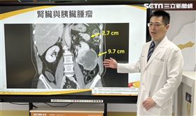 腎臟癌(圖/翻攝畫面)
