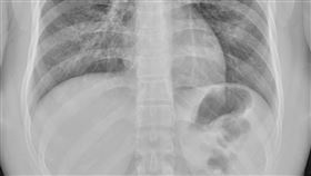 20歲女子抽電子菸染上肺癌。（圖／翻攝自蘇一峰 臉書）