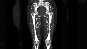  吃了沒煮熟的豬肉，感染「囊蟲病」。(圖／翻攝自X)