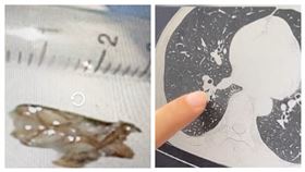 海南一名男子睡到一半被蟑螂鑽進支氣管。（圖／翻攝自微博）