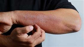 潮濕多雨的環境下，汗皰疹不斷復發。（圖／canva）
