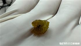 膽石／黃漢斌醫師授權提供