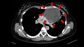 胸腔,畸胎瘤,腫瘤,馬偕（圖／新竹馬偕提供）