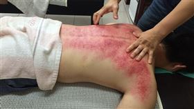 中暑刮痧(示意圖/pixabay)