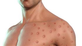 M痘。(圖／《奕起聊健康》提供）
