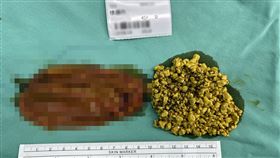 膽結石,科技新貴,輕熟女,博田醫院