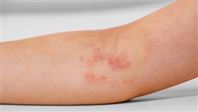 癢到破皮滲液！3招快速緩解異位性皮膚炎(圖／姊妹淘)