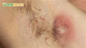 化膿性汗腺炎是一種慢性發炎的皮膚疾病，初期症狀很像青春痘，但卻是兩種不同的疾病。