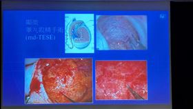 經醫師睪丸手術，患者取精成功。（圖／記者簡浩正攝影）