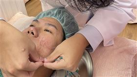 5旬男法令紋略深，且左邊嘴邊肉明顯而尋求中醫幫助，經討論後採美顏針治療。（圖／中醫師陳楚鏞提供）