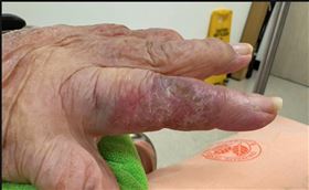 ▲蔡老太太右手無名指出現無症狀斑塊。（圖／北榮提供）