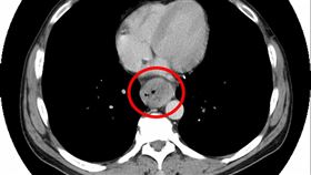 食道,癌症(圖/翻攝畫面)