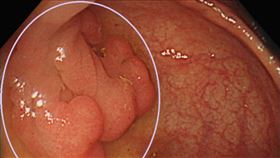 羅先生的4公分大瘜肉。（圖／烏日林新醫院提供）