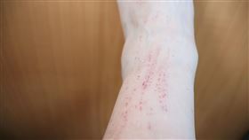 因皮膚發癢而在睡夢中抓到破皮，出現一條條的抓痕，這是典型的「秋燥」症狀。（圖／翻攝自衛生福利部彰化醫院粉專）