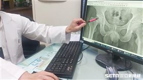 退伍軍人賣小吃　慘骨頭壞死「成因不明」／光田綜合醫院授權提供