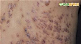 化膿性汗腺炎是一種因為自體免疫失調所引起的全身性發炎皮膚疾病，因為非感染所導致，不具傳染性。