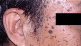 脂漏性角化症俗稱老人斑。（圖／潘企岳醫師提供）