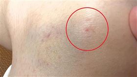 幫幼童打疫苗針扎進媽膝蓋　同針竟繼續打（圖／翻攝Threads)