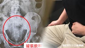 肛門塞易開罐飲料／中國醫藥大學新竹附設醫院授權提供