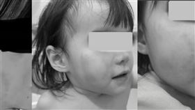 新北市永和區某幼兒園傳出疑似虐童事件，一名3歲的女童自8月起至該幼兒園托育，但身上經常出現不明瘀青，9月11日女童臉部出現不明咬痕，醫院診斷後認為女童臉上傷痕疑「成人咬痕」