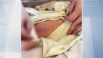 男嬰住月子中心腹瘀青12公分　家屬控受虐