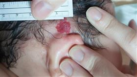 原來紅色斑塊不是胎記，竟然是新生兒血管瘤。（圖／烏日林新醫院提供）