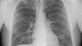 肺部(示意圖／Pixabay)