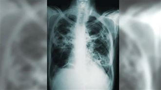 汪建民肺癌病逝！　醫嘆：轉移腦部撐不過