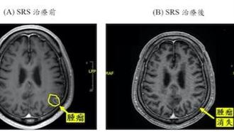 8旬翁得4病又罹肺癌 接受1治療腫瘤全消失