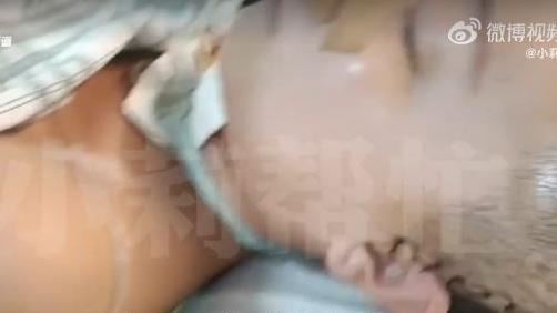 女戴鯊魚夾摔車　沒安全帽頭著地成植物人