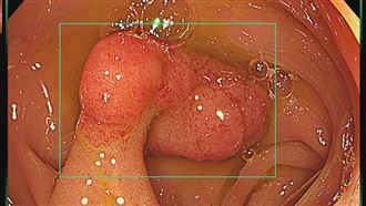 有胃息肉？醫示警「1情況」恐癌變 快切除