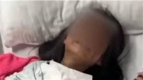 6歲女童被同學潑開水燙傷　校方指水溫異常：對方真不是故意