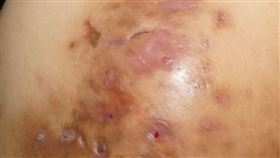 化膿性汗腺炎患者治療前。（圖／台北慈醫提供）