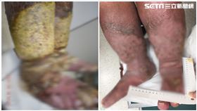 台南,夾腳拖,鞋子,象腿,奇美醫院