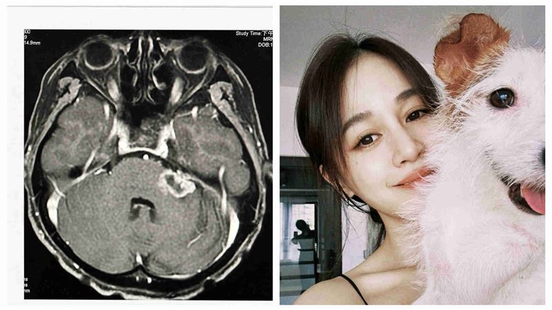 昔開顱續命　39歲女星揭腫瘤最新病況