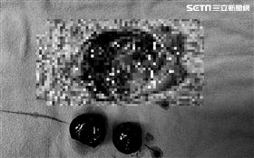 亞洲大學附屬醫院一般外科主治醫師毛士豪,膽,黑粉圓,結石(圖/亞大提供)