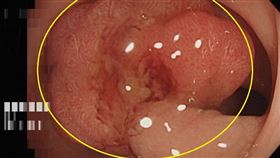 透過大腸內視鏡發現在乙狀結腸處有一個1.5公分大小的瘜肉。切片報告顯示為大腸原位癌。（圖／長安醫院提供）