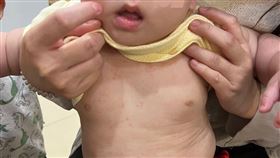 1歲童發燒3天不退，全身長滿玫瑰疹讓家長嚇壞。（圖／施勝桓醫師提供）