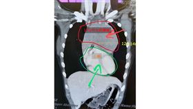 門諾醫院心臟外科黃振銘醫師說明13歲少女超大腫瘤。（圖／翻攝自門諾醫院）