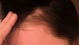 女星張馨予撥開頭髮露出禿髮的部位（翻攝張馨予微博）