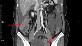 患者電腦斷層影像，紅色箭頭為腫瘤處。（圖／馬偕醫院提供）