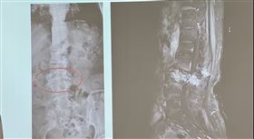 台中女雙腳疼痛無力　竟是乳癌骨轉移（圖／翻攝畫面）