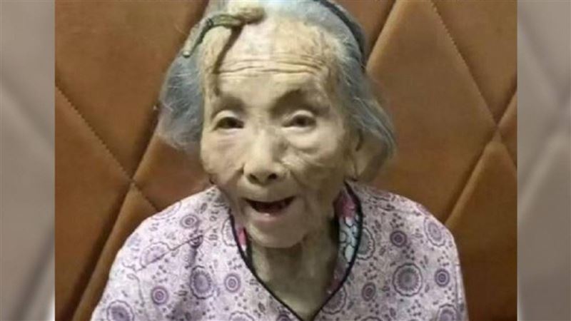 107歲老人額長角！網驚長壽角　醫揭真相